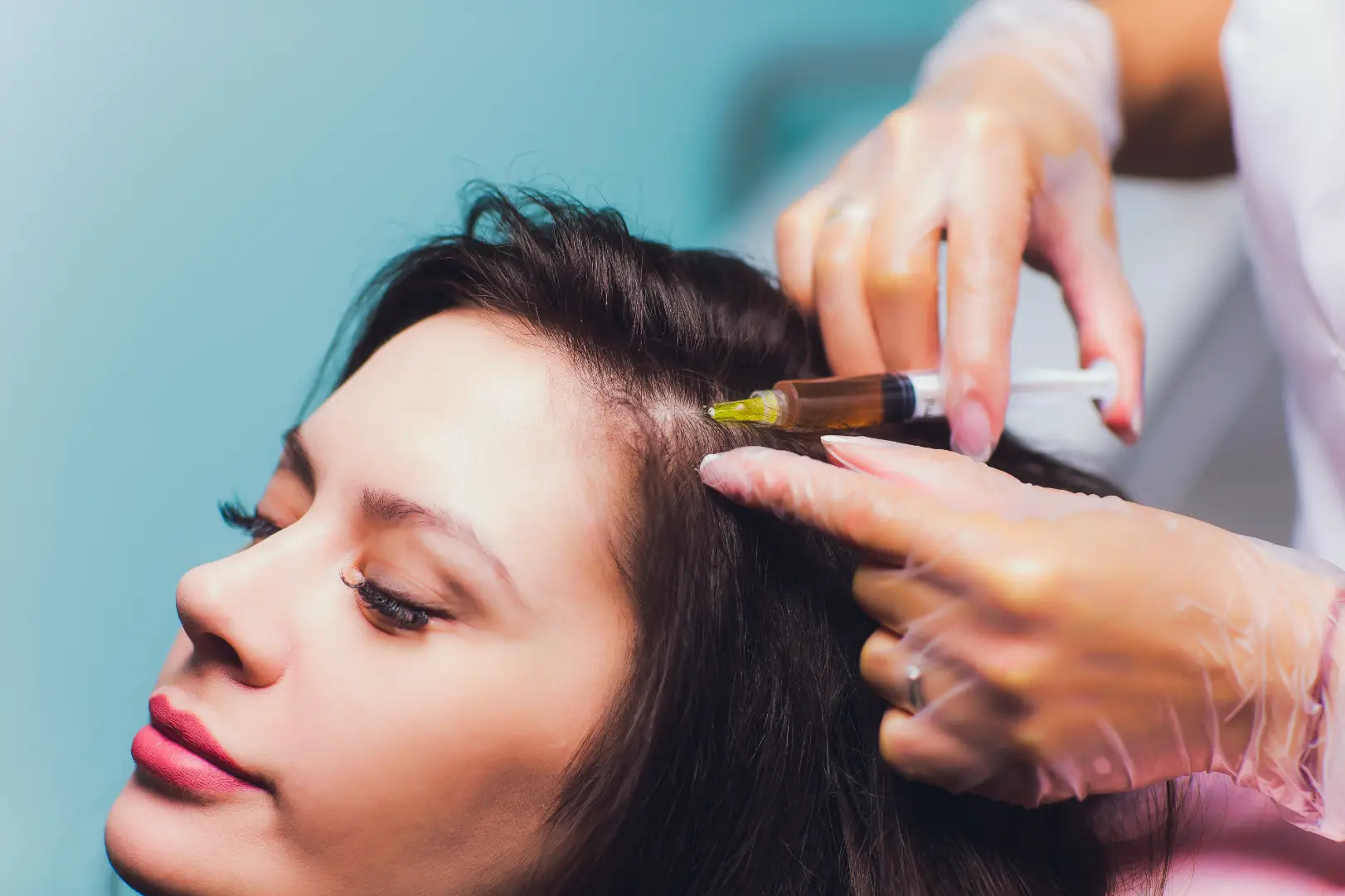 Gloved hands hold a syringe near a woman's hairline during a scalp injection procedure.